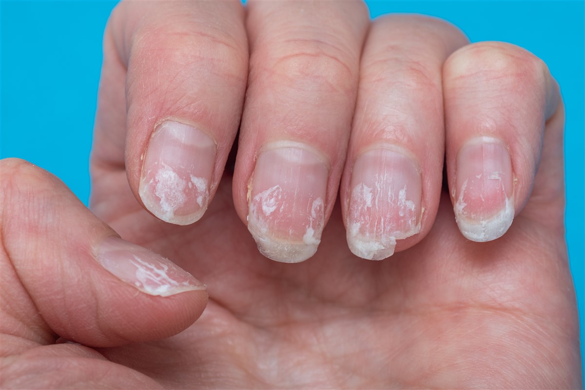 ongles fragiles